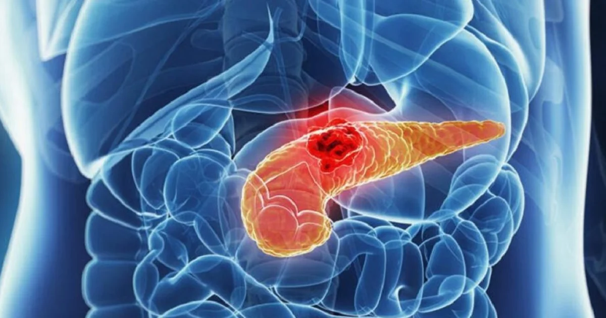 Tumore del pancreas, Ema: via libera del Chmp a daraxonrasib